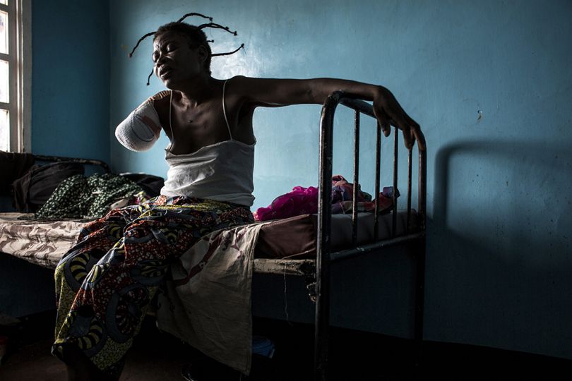 A Congolese woman who was shot in the arm. Since August 2016, in Kasai Province, 1.4 million people, now internally displaced, have fled conflict between Kamwina Nsapu, the local militia, and government troops. Tshikapa, DRC, October 23, 2017. Une Congolaise blessée par balle et amputée. Depuis août 2016, le conflit dans la province du Kasaï, entre la milice locale Kamwina Nsapu et les militaires de l’armée congolaise, a déplacé plus de 1,4 million de personnes. Tshikapa, RDC, 23 octobre 2017. © John Wessels / AFP