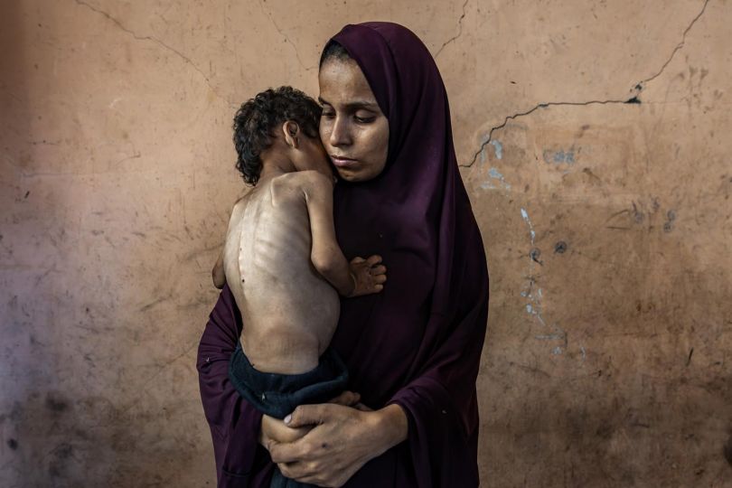 © Saher Alghorra - Do not publish without explicit ok from a manager - Clinton *The mother’s name is Naeema Abu Foul. She is 30 years old. She has four children and is pregnant with her fifth.* *** HOLD FOR HUNGER STORY *** NYTCEASEFIRE , July 19, 2025, Gaza City Yazan Abu Foul, a two-year-old child, suffers from severe malnutrition amid deteriorating health conditions. He and his family live in the remains of their destroyed home in Al-Shati refugee camp, west of Gaza City. 